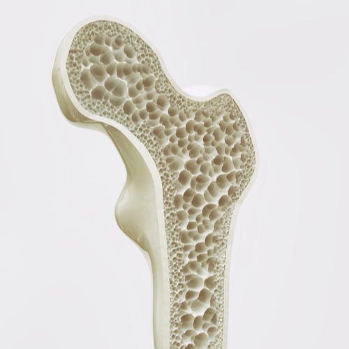 Osteoporosis Osteoporosis